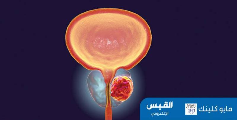 البخار يعالج تضخم البروستاتا