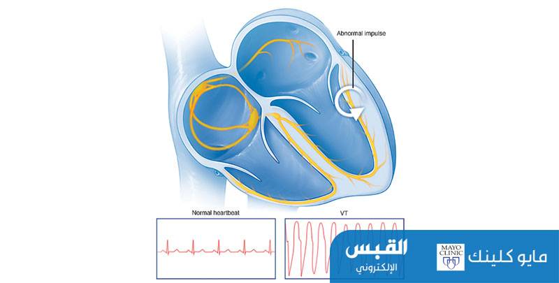 تسر ع القلب البطيني قد يؤدي إلى السكتة القلبية