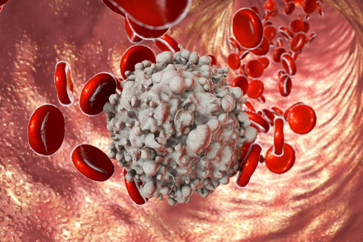 Early Warning: What Was the First of the signs of leukemia in Your Child?